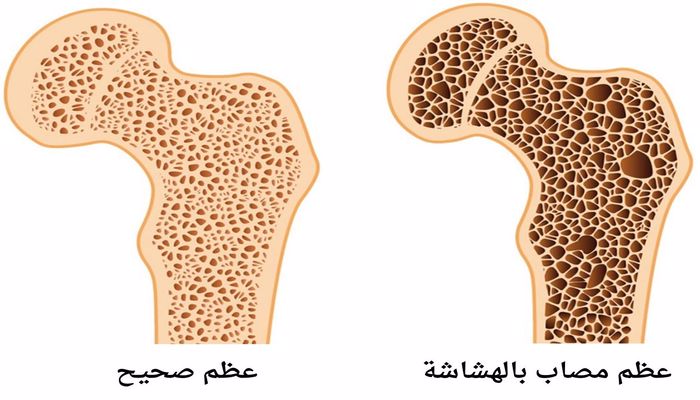 هشاشة العظام